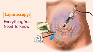 Laparoscopy Surgery: Purpose, Procedure, & Benefits.